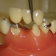 Zubní můstek 1