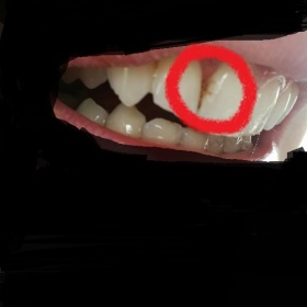 Zubní kámen vs. zubní kaz